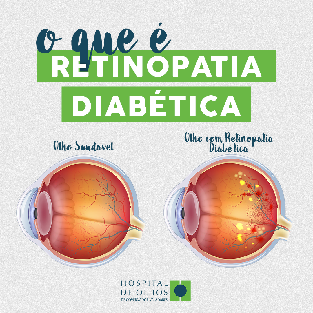 Retinopatia Diabetica Hospital De Olhos De Governador Valadares